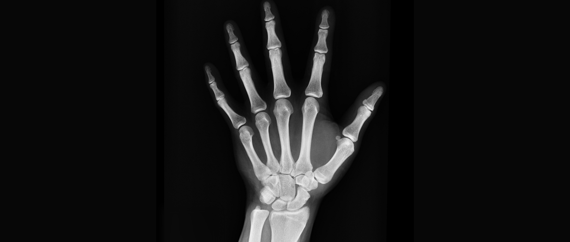 xray of person's hand