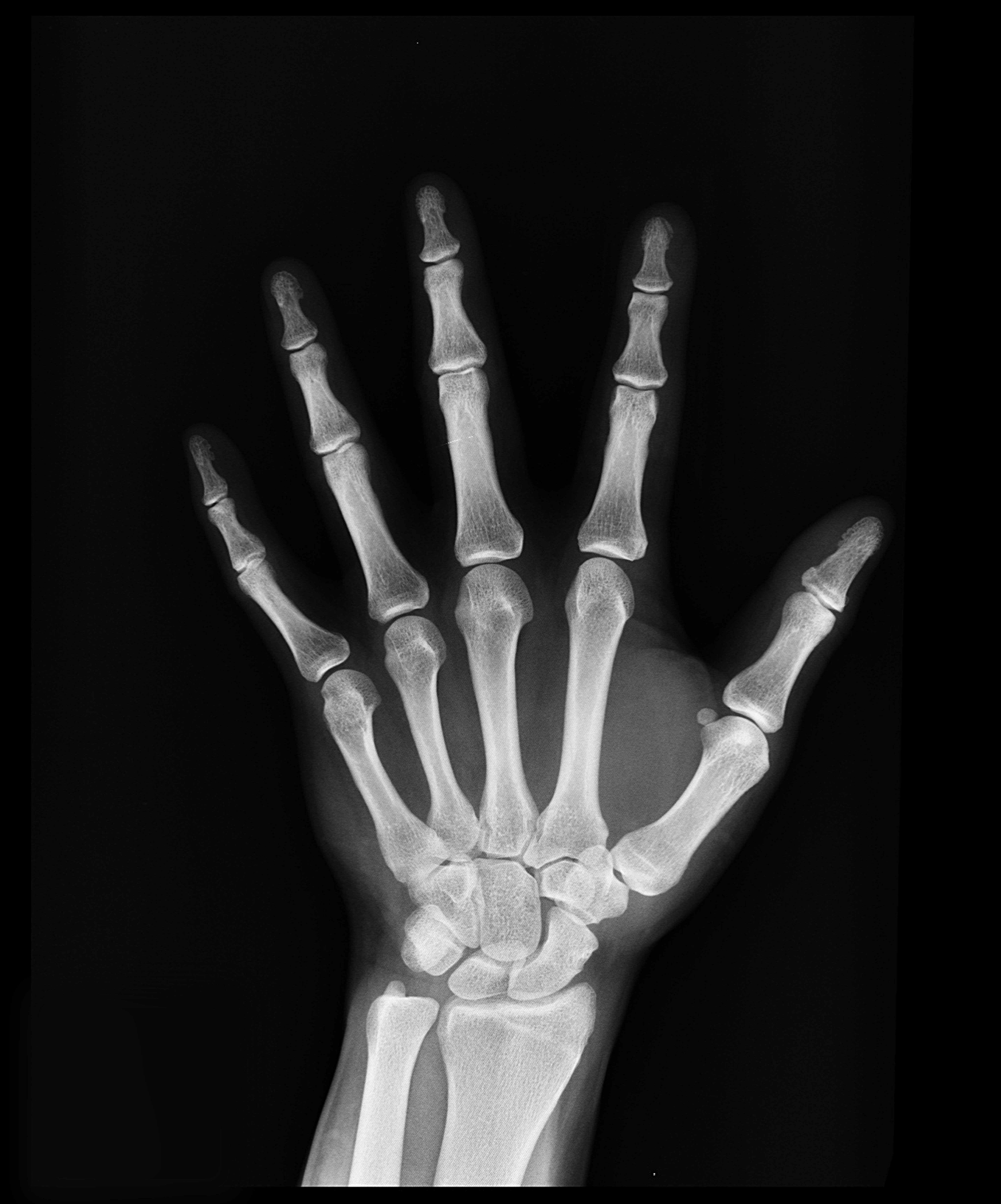 Image of a fracture on xray