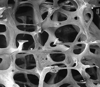 OsteoporoticBone.jpg
